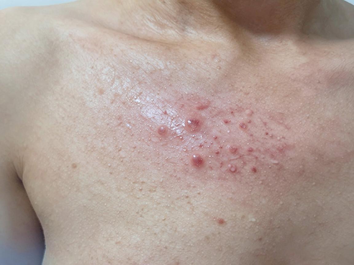 在合肥，针对腋臭（狐臭）的治疗，建议优先选择三甲医院的整形美容科、皮肤科或腋臭专科门诊。这类医院设备先进、医生经验丰富，且能提供微创手术、激光治疗等主流方案