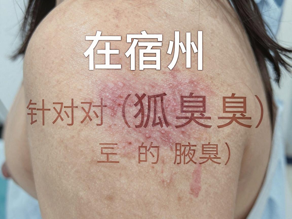 在宿州，针对狐臭（腋臭）的治疗，公立医院的皮肤科或普外科（或整形外科）通常会比较权威。以下是当地口碑较好、相关技术较为成熟的几家医院供你参考