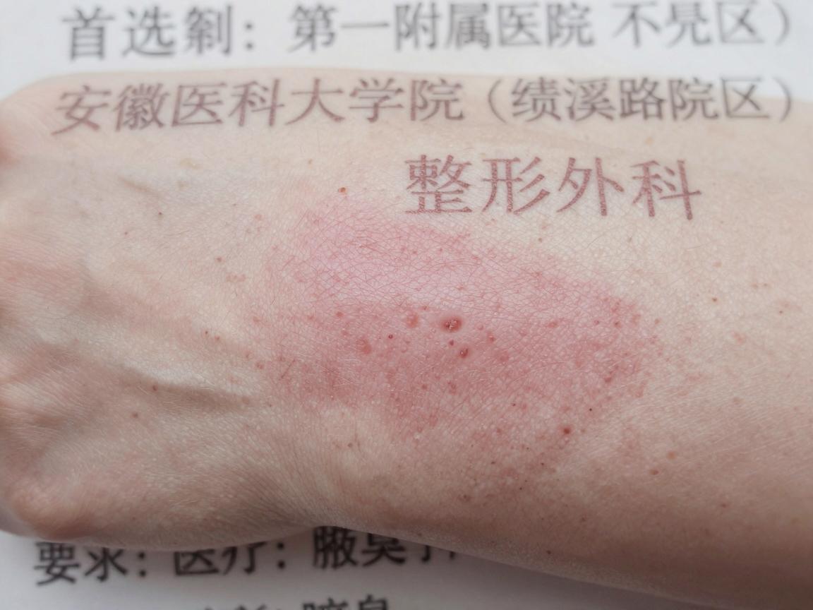 首选，安徽医科大学第一附属医院（绩溪路院区）整形外科